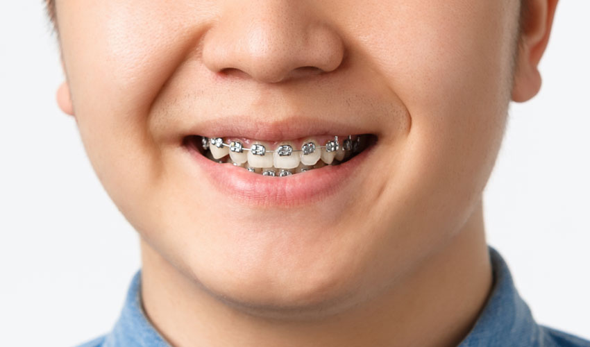 Ortodonti (Diş Teli Tedavisi)